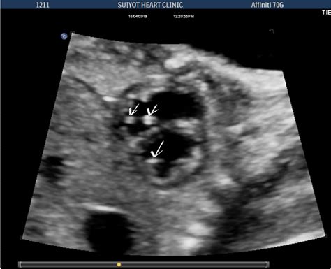 lv echogenic focus|echogenic heart focus meaning.